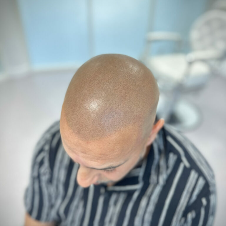 bordeaux-tricopigmentation-10