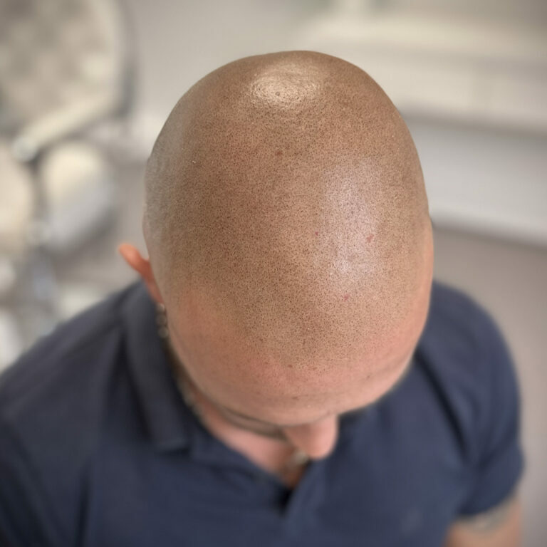 bordeaux-tricopigmentation-25