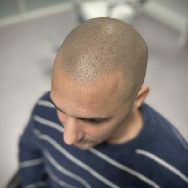 tarif-tricpigmentation-bordeaux